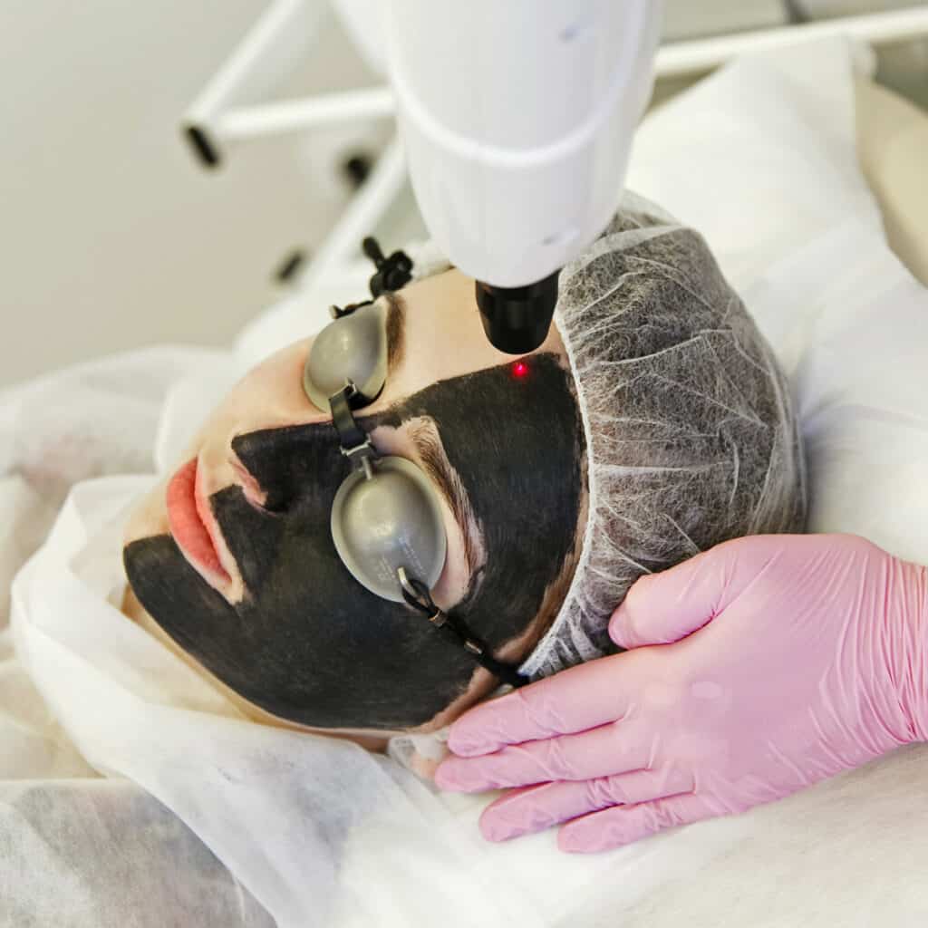 Carbon laser facials